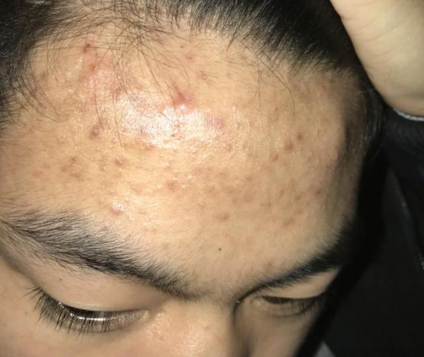 头皮长脓包怎么办用什么药膏,头皮长脓包怎么治疗用什么药