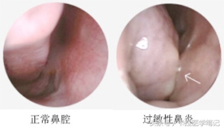 春季总是犯鼻炎或皮肤过敏，盘点10种过敏原的预防