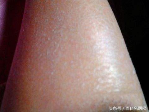 湿气会皮肤瘙痒,湿气会使毛孔发痒