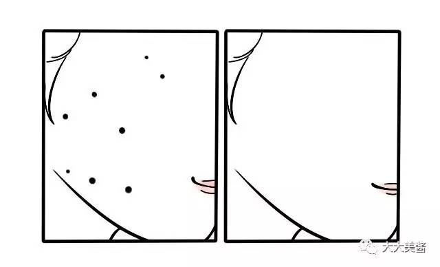 小激光点痣,激光点痣全过程视频