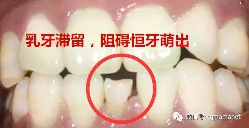 一般小孩几岁换牙齿才正常呢,十岁左右儿童牙齿常见问题