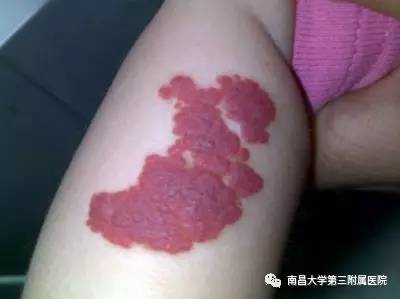 哪些胎记有危险,宝宝胎记是什么原因造成的