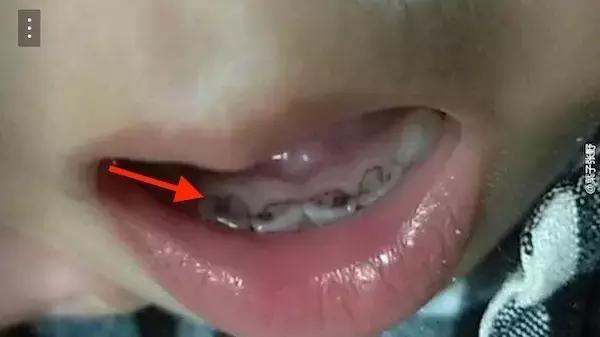 孩子的牙黑怎么办,孩子换过的牙又黄又黑
