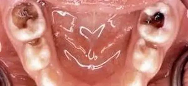 孩子的牙黑怎么办,孩子换过的牙又黄又黑