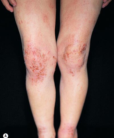 孩子湿疹吃什么药,8岁孩子湿疹