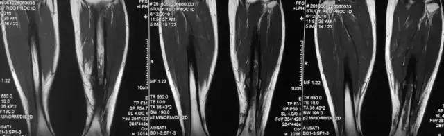 骨折内固定伤口处流脓是为什么,骨折固定支架外部流脓怎么处理