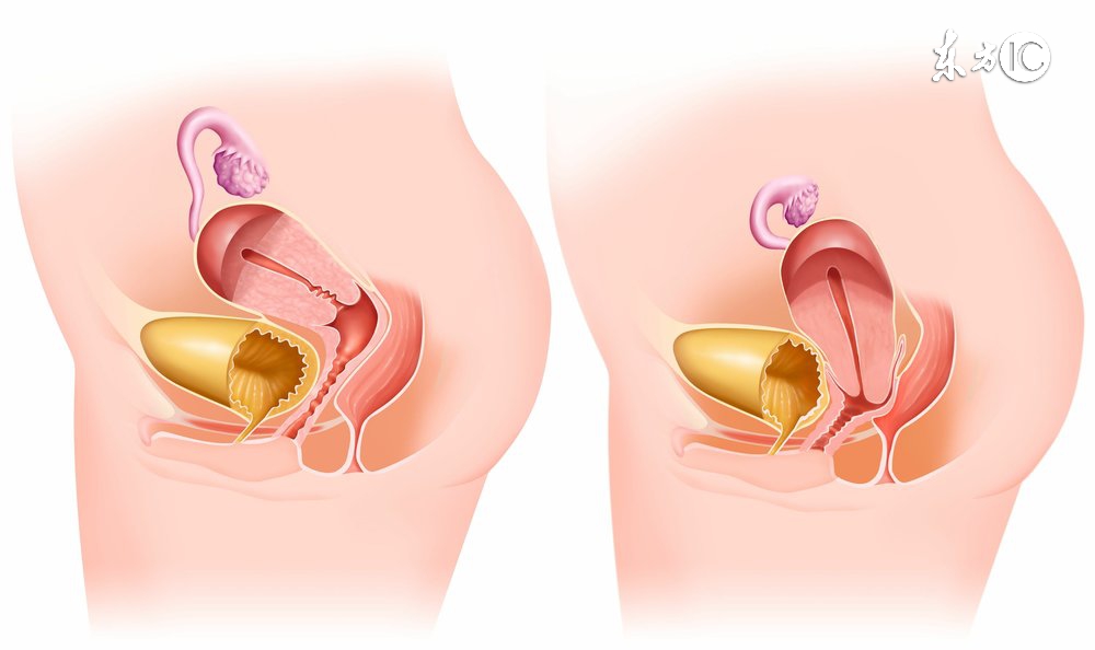 宫颈癌晚期能活过5年的吗,宫颈癌晚期能活过15年吗