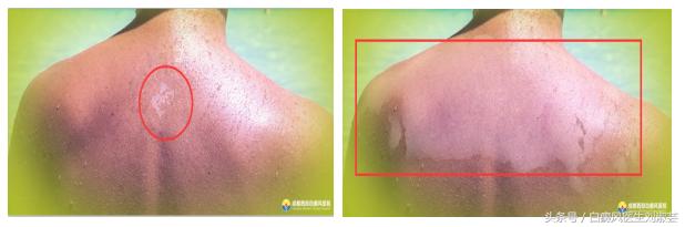 得了白质病要怎么治疗,患白