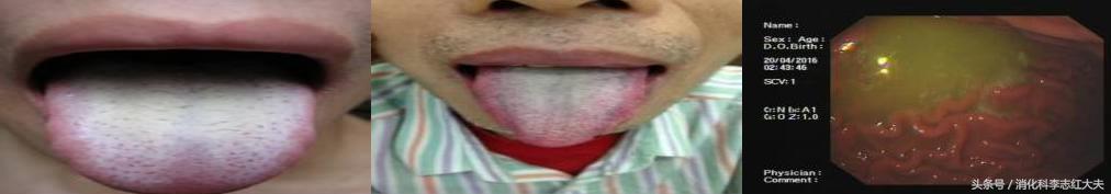 反流食管炎加萎缩性胃炎中医治疗,反流性食管炎中医把脉能看出来吗