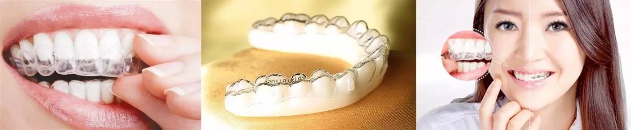 隐形牙套整牙全过程介绍,拔掉四颗牙隐形牙套矫正的全过程