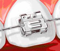 隐形牙套整牙全过程介绍,拔掉四颗牙隐形牙套矫正的全过程