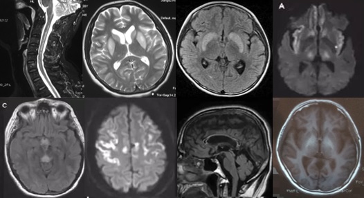 中枢神经脱髓鞘病是重大疾病吗,中枢神经系统脱髓鞘和多发性硬化