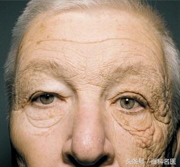 毛孔粗大黑头多脸爱出油怎么解决,毛孔粗大黑头多有闭口脸色暗沉