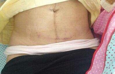 剖腹产总感觉撕裂疼,剖腹产麻药过的伤口痛还是顺产疼