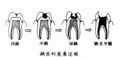 蛀牙了怎么防范再继续蛀牙下去,蛀牙居然是这样解决的