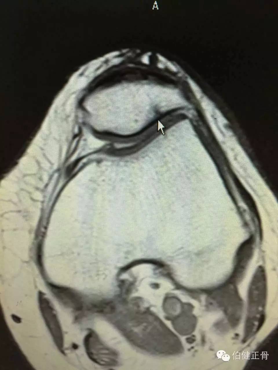 髌骨软化症怎么治疗效果好,髌骨软化症膝盖疼怎么治疗