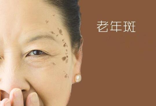 老年斑会导致雀斑吗,老年斑长大有危险吗