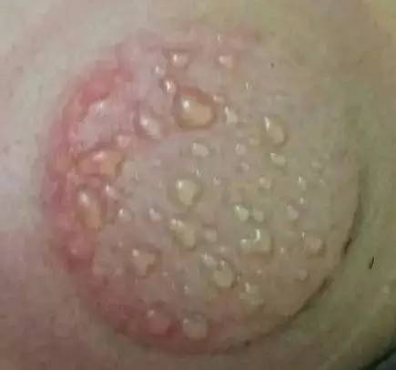 拔罐的危害到底有多可怕,拔罐后千万不要做这3件事