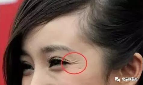 鱼尾纹，这样除最简单，一针即刻见效！