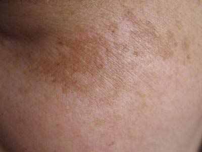 去除斑点最有效的方法,去除斑点的最有效方法