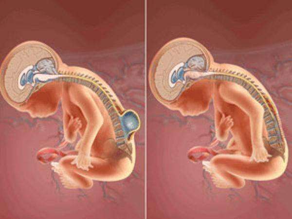 隐性脊柱裂怎么治疗最好,骶1隐性脊柱裂如何治疗