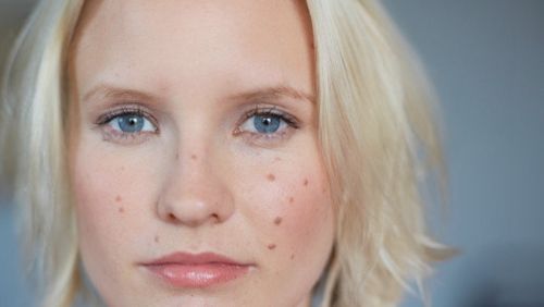 祛痘印的方法最快最有效,祛痘印最好的4个方法