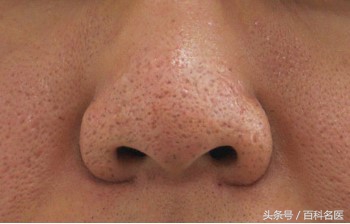 毛孔黑头的大救星,脸油干燥粗糙毛孔粗大黑头多