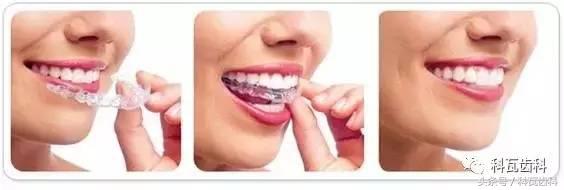 门下门牙有缝隙怎么补救,门牙开缝怎么处理最好