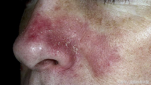 头皮屑多且脂溢性皮炎,头皮屑多头痒脂溢性皮炎