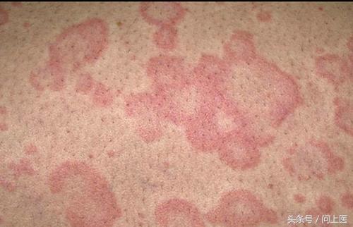 图解成年人常见的皮肤问题