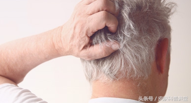 头皮屑多且脂溢性皮炎,头皮屑多头痒脂溢性皮炎