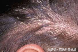 头皮屑多且脂溢性皮炎,头皮屑多头痒脂溢性皮炎