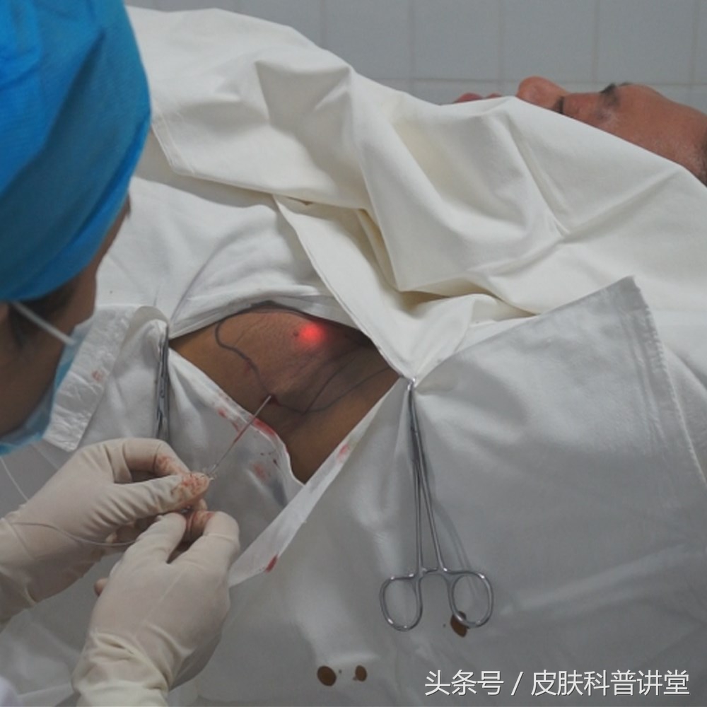 夏天腋臭怎么去除最快,祛除腋臭最彻底的治疗方法