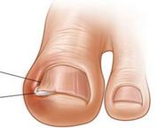 喜欢美甲的女孩要注意一种疾病：嵌甲