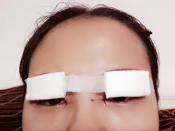 全切双眼皮15天,恢复的差不多了