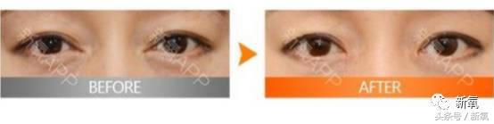 为什么开眼角会变漂亮,为什么开眼角很奇怪