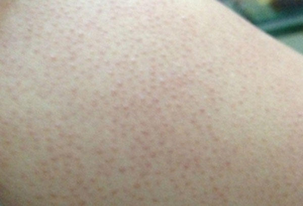 一招根除鸡皮疙瘩,怎么缓解鸡皮疙瘩