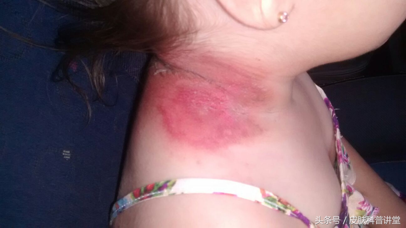 隐翅虫皮炎部位睡觉需要避开吗,晚上睡觉怎么避免隐翅虫