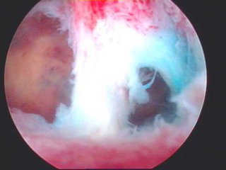 人流术后为什么月经量少,人流术后月经变少是粘连吗