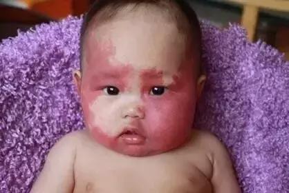 女儿有红胎记，妈妈是这样做的！