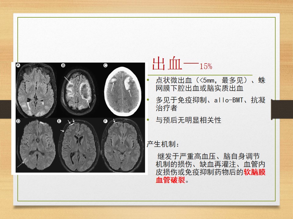 可逆性后部白质脑病综合征中央型,可逆性后部白质脑病综合征啥症状