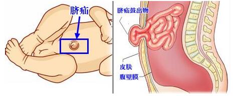 新生儿脐疝如何处理,新生儿脐疝初期怎么处理