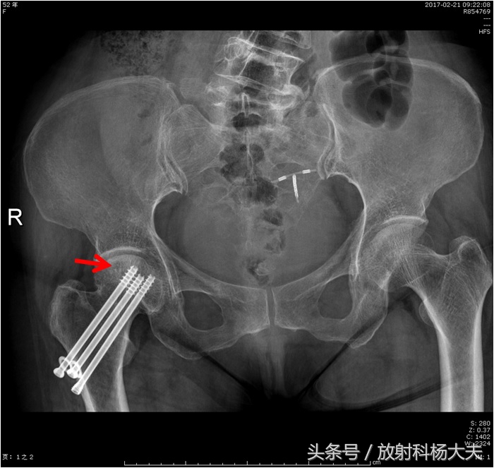 股骨骨折手术五个月拄拐杖走路疼,股骨头坏死手术后一个月腿弯疼