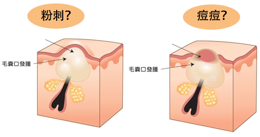 黑头粉刺满是痘痘,粉刺和痘痘肌的区别