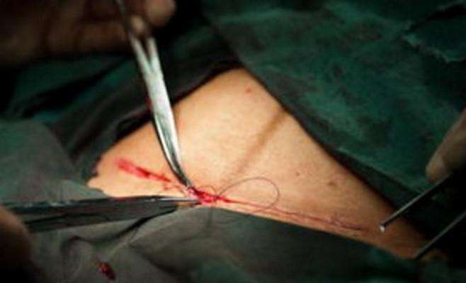 一层层，一刀刀切开孕妇肚子，剖腹产并不是你想象的那么简单