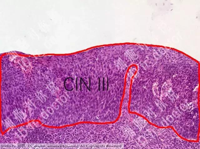 宫颈高度病变镜下观察,宫颈镜下可疑浸润癌严重吗