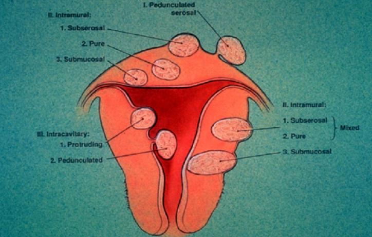 推迟八天来例假查出子宫肌瘤,月经推迟了显示子宫肌瘤