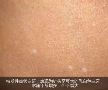 不是白癜风的白斑能查出是什么吗,不是白癜风的白点是啥