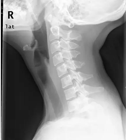 玩手机颈椎保护神器儿童,儿童玩手机颈椎弯曲如何康复