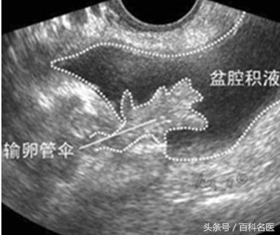 孕早期有盆腔积液怎么办,盆腔积液治疗方法有哪些